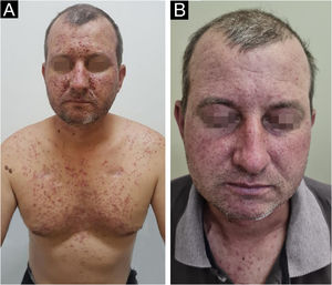(A) A 40-year-old patient with grade 3 acneiform eruption due to the use of panitumumab for colorectal cancer. (B)The same patient after 14 days using doxycycline 100 mg twice daily.