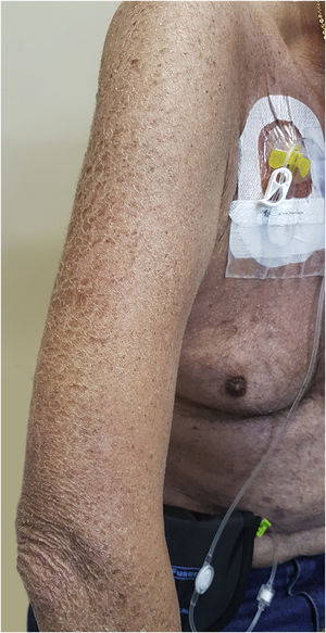 A 63-year-old patient using cetuximab for the treatment of colorectal carcinoma with severe xerosis.