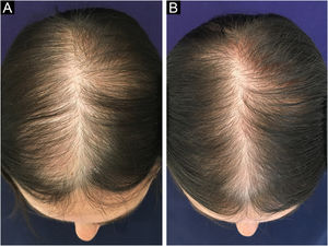 Clinical improvement in a patient with FPHL using minoxidil 5% solution 1× a day. (A) Before treatment. (B) After six months of treatment.