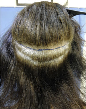 Area from which the skin strip will be removed for the extraction of follicular units (FUT - Follicular Unit Transplantation technique).