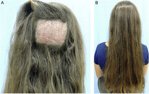 (A) Shaved area for removal of follicular units using the FUE (Follicular unit extraction) technique. (B) Long hair covering the shaved area.