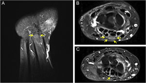 Magnetic resonance imaging of the right wrist. (A) Sagittal view showing thickening of the median nerve (arrows). (B) Axial view showing thickening of the median nerve in the carpal tunnel (arrows). (C) Nerve showing normal thickness outside the carpal tunnel (arrow).
