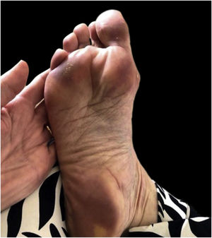Pseudochilblains.