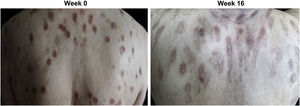 Clinical response of prurigo nodularis to dupilumab treatment. (A) Multiple reddish brown, firm, and hyperkeratotic skin nodules were distributed extensively across the upper back at week 0 (baseline) prior to dupilumab treatment. (B) Prurigo nodules showed significant regression accompanied by post-inflammatory hyperpigmentation and the absence of erosion or excoriation by week 16 of treatment with dupilumab.