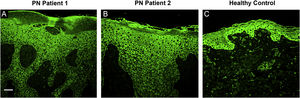 Immunofluorescence staining of IL-17RA (green) in two patients’ lesional skin biopsy specimens before dupilumab initiation. (A) Immunofluorescence staining of IL-17RA in PN Patient 1 showing hyperkeratinization, irregular acanthosis, and hypergranulosis. IL-17RA positive keratinocytes can be observed in parts of the stratum granulosum and the stratum spinosum. (B) Immunofluorescence staining of IL-17RA in PN Patient 2 showing hyperkeratinization, irregular acanthosis, and hypergranulosis. IL-17RA positive keratinocytes can be observed in large areas of the stratum granulosum and the stratum spinosum. (C) Immunofluorescence staining of IL-17RA in control specimen showing some IL-17RA positive keratinocytes in the stratum basale. Bar = 100 μm. IL-17RA- interleukin-17A receptor; PN- prurigo nodularis.