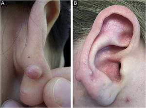 Keloid formation following piercing through the transitional zone in patient 1 (A) and patient 2 (B). There is no keloid formation at the earlobe piercing points in both patients.