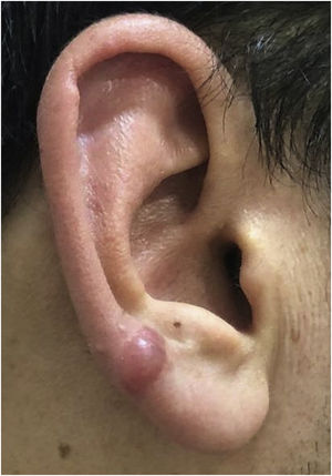 Keloid formation following piercing through the transitional zone in patient 3.