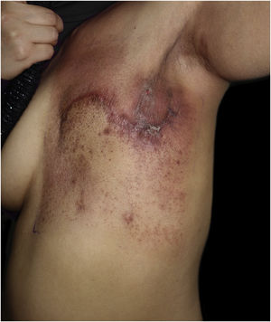 Well-demarcated rectangular erythema with edema, tiny papules, and erosions affecting the left chest and axillary region.