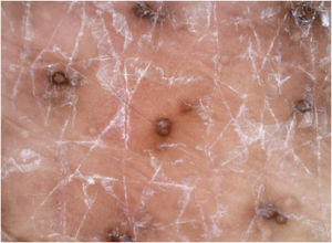 The dermoscopy showed multiple brown circles along with the hair follicles as well as white scales.