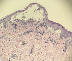The histopathology revealed intraepidermal vesiculation, papillary dermal edema, and perivascular inflammatory infiltrate in the upper dermis (Hematoxylin & eosin, ×100).