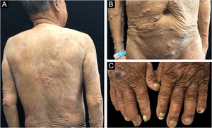 Clinical aspect: (A‒C) Multiple papules and subcutaneous nodules and onychomycosis.