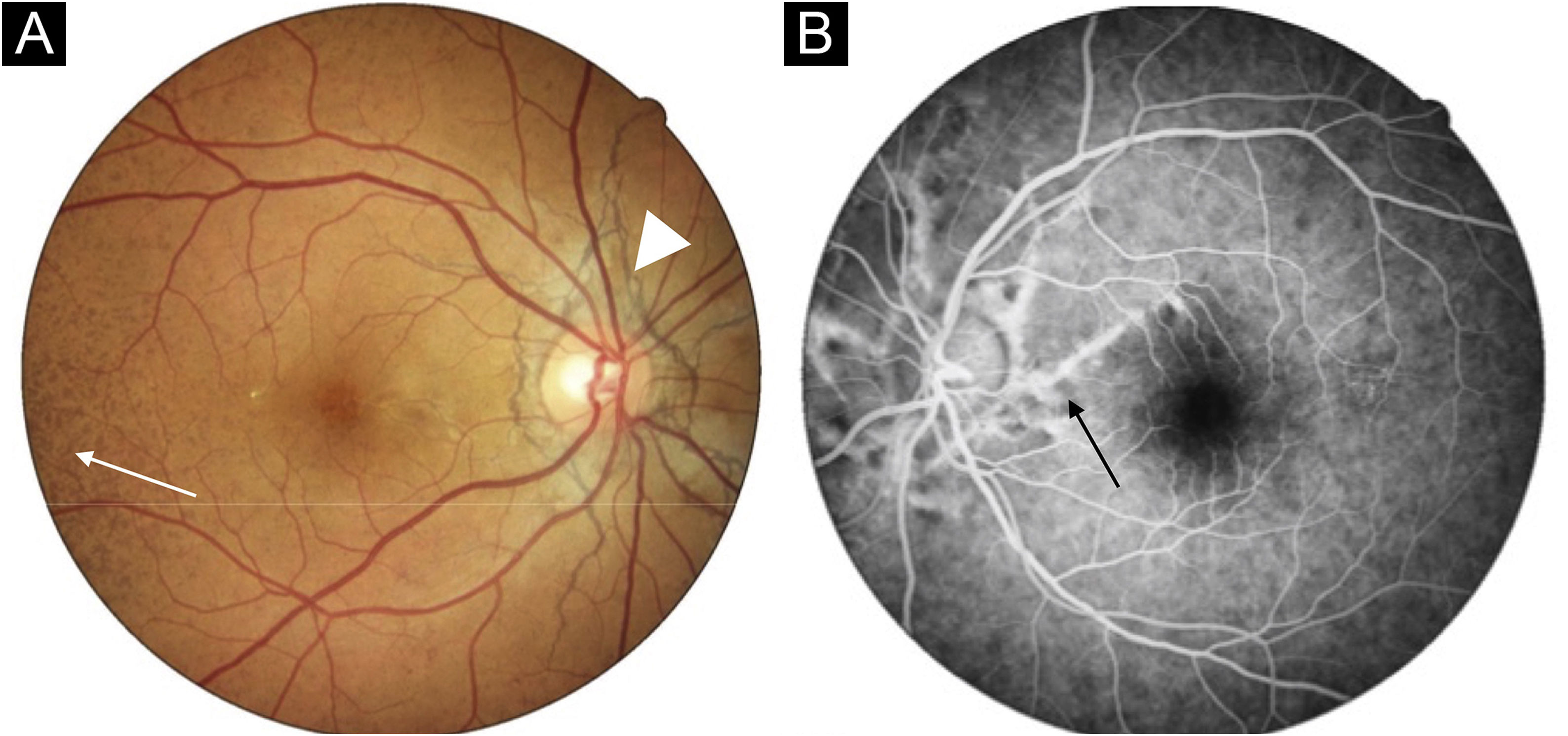 Diagnosis of pseudoxanthoma elasticum in a patient with discrete skin ...