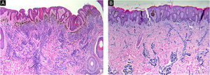 Histomorphologic features of CMN. Congenital growth pattern in nevi involving adnexal epithelium and wrapping of nevus cells around vessels and splaying of melanocytes in-between collagen bundles (A‒B). But the nevi with BRAF V600E mutation (A) would spread into deep dermis even deeper than wild type nevi (B). (A‒B, Hematoxylin & eosin, ×40).