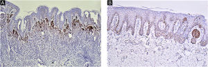 Ki67 immunohistochemistry of CMN. Ki67 staining was restricted to the nucleus of positive cells in a distinct granular pattern of staining and more frequently observed at the dermal-epidermal junction (A‒B, ×100).