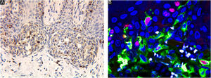The brown stained nuclei indicate Ki67 positive expression (A, ×400). Confocal laser fluorescence microscopy can easily eliminate the interference of melanin granules. Cells with red fluorescence in the center and yellow fluorescence around are Ki67 positive cells (B ×600).