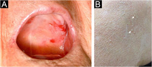 Clinical features of the present case. (A) Erosions on the soft and hard palate. (B) Milia seen over previously erosive PV lesions on the shoulder (arrows).