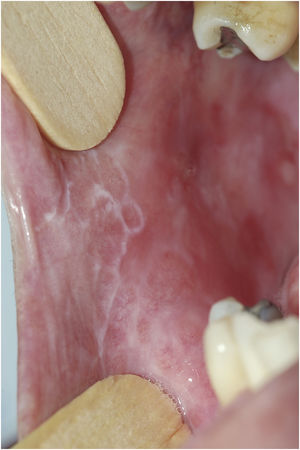 Isolated papular, reticular and annular lesions in the same patient. They can be considered together (“leukokeratotic lesions”) because there is no difference in the approach. There are also erosive and atrophic areas.