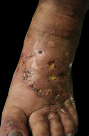 Right foot, aspect of the dorsum one year after onset of the condition: mild livedo racemosa, hypochromic atrophic scars with telangiectasias, ulcers with erythematous background, some covered by fibrinopurulent tissue and others by hematic crusts.