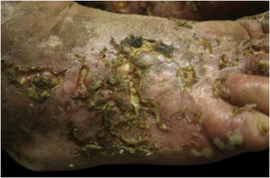 Right foot, aspect of the dorsum: pustules and ulcers with erythematous background, many crusts and concretions, hypochromic atrophic lesions and other hyperchromic ones.