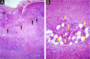 Chronic ulcer: (A) hyperplastic epidermis at the edge (red arrow), vessels with hyalinized walls at the edge and in the ulcer bed (black arrows), inflammatory cell aggregates and fibrosis of the reticular dermis and hypodermis; (B) wall hyalinosis and occlusive thrombosis of the lumen in the dermis and hypodermis vessels (yellow arrows), with inflammatory exudate containing polymorphonuclear neutrophils. Hematoxylin & eosin, x40 (A) and x100 (B).