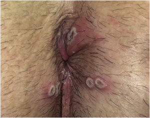 Clinical image. Perianal whitish papules with a necrotic center (pseudopustules).