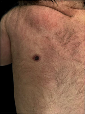 Ulcerated lesion with central crust and elevated pink border located on the left scapular region.