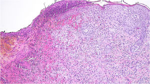 Ulcerated lesion with an infiltrate composed of epithelioid cells with kidney-shaped nucleus, with epidermotropism (Hematoxylin & eosin, ×100).