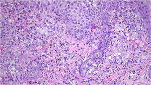 Infiltrate composed of epithelioid cells with kidney-shaped nucleus, accompanied by lymphocytes, plasma cells and a significant number of eosinophils (Hematoxylin & eosin, ×200).