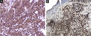 Positive immunostaining for CD1a (A, ×200) and langerin (B, ×100).