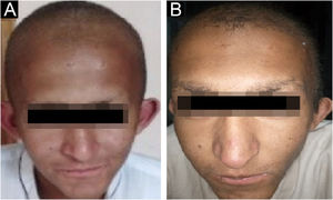 Facial photographs of affected individuals (V-3) and (V-4) are shown in panel A and B respectively. Sparse scalp hair, sparse eyebrows and eyelashes and deformed pinnae of both ears are clearly evident
