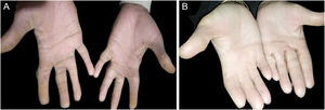 Hands of affected member (V-4) and (IV-9) showing large palm size, short fingers, dry scaly skin, keratoderma, and proximal cutaneous syndactyly of 2nd, 3rd and 4th fingers in V-4 (A) and in right hand of IV-9 (B)