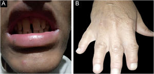 (A) Peg-shaped, conical, and widely spaced teeth with enamel hypoplasia. (B) Hand of an affected member (IV-9) showing hypoplastic, discolored nail plate