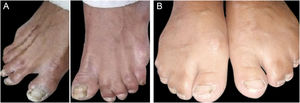 (A) Feet of an affected member (V-3) showing bilateral 2‒3 toes syndactyly (B) Feet of an affected mother (IV-9) showing fusion of 2nd to 5th toes up to distal interphalangeal joint