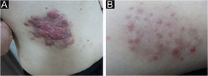(A) Infiltrating plaque type: infiltrating yellow-red plaque, with uneven surface, and multiple dark red nodules of different sizes at the edge. (B) Nodular papule type: local distribution of multiple red papules of 0.2‒0.5 cm in size on the surface of pale erythema, showing isolated and non-fused shape