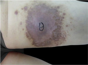 Tumor like type: Dark red palm-sized mass on flexor aspect of left thigh with obvious central uplift and multiple dark red nodules in the surrounding surface