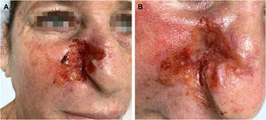 (A) Infiltrated erythematous plaque with exudation, crusts and ulceration in the right malar region, on photodamaged skin. (B) Exuberant vascular proliferation extending to the right nasal ala