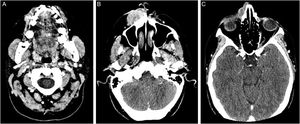 Computed tomography of the face and neck: (A) proximity of the neoplasm to the dental root of the upper right canine. (B) solid expansive lesion with wide superficial ulceration, extending to the nasal ala and right maxillary region, measuring 3.6 × 1.9 × 4.5 cm. (C) nasal bone destruction and upper extension, close to the right orbit. The tumor shows marked and heterogeneous contrast enhancement
