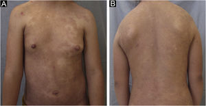 (A and B) Resolution of skin lesions after 36 sessions, 4 months of treatment, with NR-UVB phototherapy