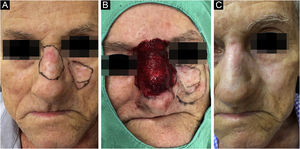 Patient with demarcation of two contiguous lesions of nodular basal cell carcinoma (A), surgical procedure, with demmarcated surgical margins, and one of the lesions in the post-treatment period with microinfusion of drug into the skin (B), and outcome after six months of treatment (C)