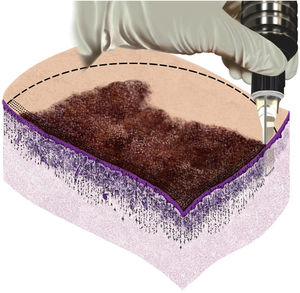 Lesion with demarcated surgical margin, cartridge needles adjusted to maximum depth, and bleomycin evenly distributed throughout the lesion and safety margin