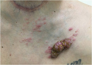 Tumor lesion with papules and satellite erythema on the anterior thorax in a patient with cutaneous metastasis of thyroid cancer. Note the previous thyroidectomy scar
