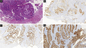 (A) Atypical nodular proliferation in the deep dermis in a patient with cutaneous metastasis of colon adenocarcinoma (Hematoxylin & eosin, ×100). (B) Positive CK7, (C) CDX2 and (D) EMA corroborate the diagnosis