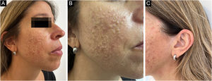 (A‒C) Numerous distinct (1‒3mm) smooth skin-colored papules concentrated on the cheeks and the ears