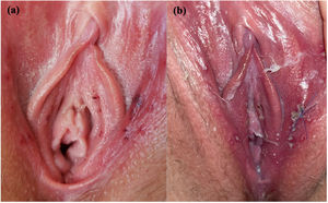 Progression of vulvar aphthosis. (A) Initial clinical presentation, with millimetric, shallow, purple-red, ulcerations, (B) Day 1 follow-up. Labia majora and minora with edema and erythema. Ulcerations with purulent center