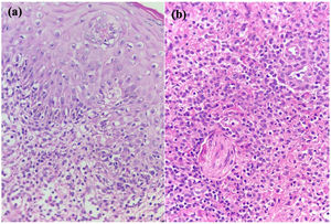 Biopsy of one ulcer stained with Hematoxylin & eosin, 40x. (A) Vulvar mucosa ulceration and spongiosis. (B) Dense mixed inflammatory infiltrate of lymphocytes, histiocytes, and scarce monocytes in all the stroma.
