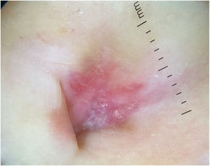 Characteristic white streaks on a violaceus background could be observed under dermoscopy