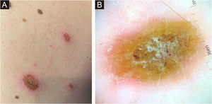 (A) Erythematous-squamous lesions and crusting over approximately half of his melanocytic nevi on the trunk. (B) Visualization of dermoscopic structures was difficult due to the presence of serous crusting, slight whitish scaling, and an erythematous halo