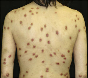 A number of nodular prurigo on the back