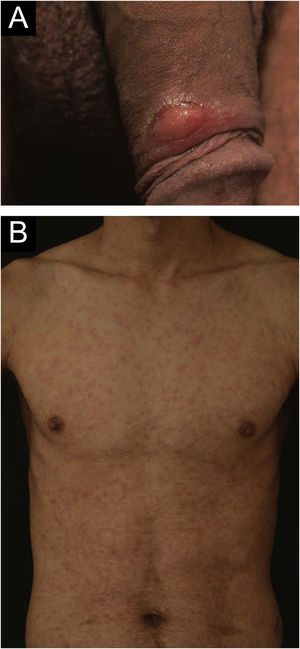 (A) Ulcer with well-defined edges, erythematous bed, located in the foreskin. (B) Multiple erythematous papules distributed on the trunk