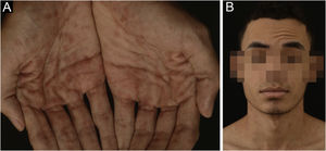 (A) Multiple erythematous papules distributed on the palms. (B) Peripheral facial nerve palsy